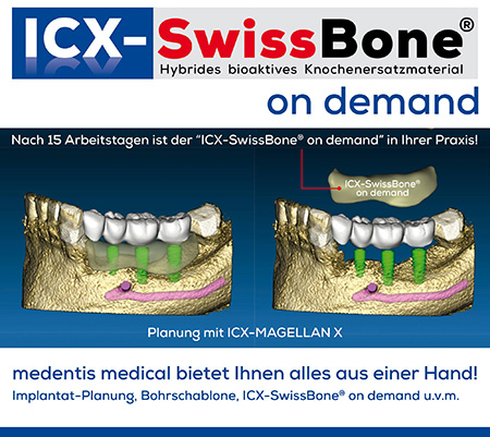 ICX-SwissBone?: