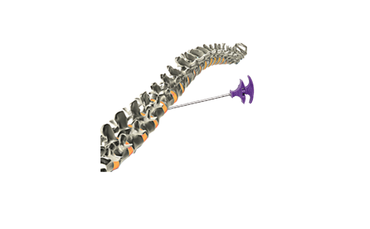 新的脊柱微创术式- 经皮椎体成形术