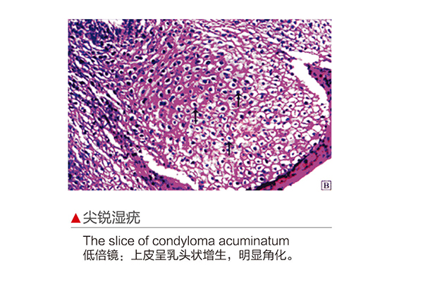 D130007.尖銳濕疣