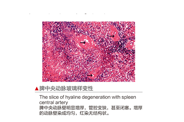 D130006.脾中央動(dòng)脈玻璃樣變性